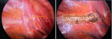 告別滴水 重獲干爽 遵醫(yī)附院胸外科助力患者微創(chuàng)除手汗1107.png