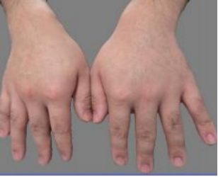 告別滴水 重獲干爽 遵醫(yī)附院胸外科助力患者微創(chuàng)除手汗1174.png