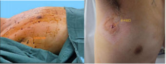 告別滴水 重獲干爽 遵醫(yī)附院胸外科助力患者微創(chuàng)除手汗1007.png